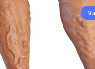 ყველაზე ძვირფასი წამალი ვარიკოზული ვენების სამკურნალოდ! გამოდგება ყველა სეზონზე!!!