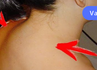 მეთოდი, რომლის გამოყენებითაც კისერზე მარილებს დაშლით!! ეს ნაცადი და ნამდვილი რეცეპტია!