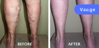 ამ რეცეპტმა ჩემზე დიდი შთაბეჭდილება მოახდინა. გაგანიერებული ვენების მკურნალობა ამ მეთოდით ყველაზე ეფექტური და სწრაფი აღმოჩნდა!