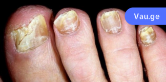 ფეხის სოკოს სამკურნალო ნატურალური საშუალება! რეცეპტი, რომელმაც უამრავი ადამიანი გააბედნიერა!