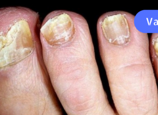 ფეხის სოკოს სამკურნალო ნატურალური საშუალება! რეცეპტი, რომელმაც უამრავი ადამიანი გააბედნიერა!