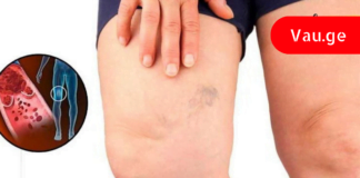 ცნობილი კარდიოლოგის მიერ დასახელებული 6 საკვები, რომელიც სისხლს ათხელებს