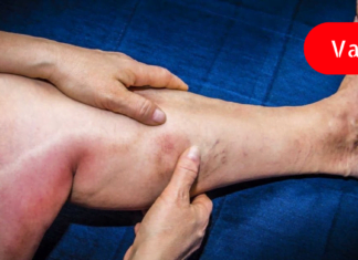 უებარი სამკურნალო ნაყენი თრომბოზისა და ვარიკოზული ვენების დროს. მკურნალობის კიდევ რამდენიმე მარტივი და იაფი რეცეპტი