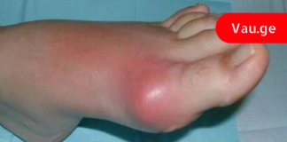 სამუდამოდ დაემშვიდობეთ პოდაგრას ამ ძლიერი ბუნებრივი რეცეპტით!