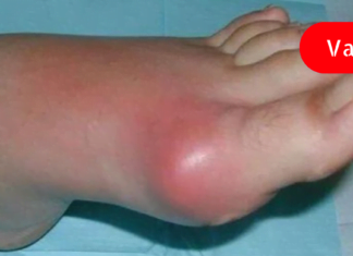 სამუდამოდ დაემშვიდობეთ პოდაგრას ამ ძლიერი ბუნებრივი რეცეპტით!