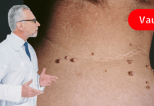 პაპილომების მოსაცილებელი 9 საშუალება: მარტივი, უმტკივნეულო და ბიუჯეტური!