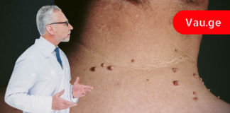 პაპილომების მოსაცილებელი 9 საშუალება: მარტივი, უმტკივნეულო და ბიუჯეტური!