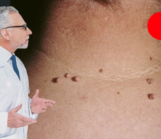 პაპილომების მოსაცილებელი 9 საშუალება: მარტივი, უმტკივნეულო და ბიუჯეტური!