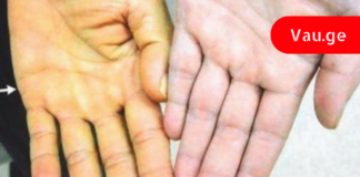 14 სიმპტომი, რაც ღვიძლის დაავადებაზე მიგითითებთ! ეს არ უნდა დააიგნოროთ!