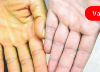 14 სიმპტომი, რაც ღვიძლის დაავადებაზე მიგითითებთ! ეს არ უნდა დააიგნოროთ!