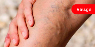 მოიშორეთ სისხლძარღვოვანი “ვარსკვლავები” ფეხებიდან წამლებისა და ოპერაციის გარეშე