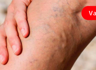 მოიშორეთ სისხლძარღვოვანი “ვარსკვლავები” ფეხებიდან წამლებისა და ოპერაციის გარეშე