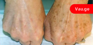 გიცდიათ ოდესმე პიგმენტური ლაქების მოცილება ამ მეთოდით? გაოცებული ვარ შედეგით!