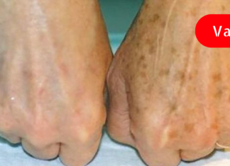 გიცდიათ ოდესმე პიგმენტური ლაქების მოცილება ამ მეთოდით? გაოცებული ვარ შედეგით!