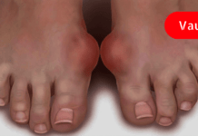 სამუდამოდ დაემშვიდობეთ პოდაგრას ამ დროში გამოცდილი ბუნებრივი საშუალებით!