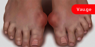 სამუდამოდ დაემშვიდობეთ პოდაგრას ამ დროში გამოცდილი ბუნებრივი საშუალებით!