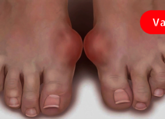 სამუდამოდ დაემშვიდობეთ პოდაგრას ამ დროში გამოცდილი ბუნებრივი საშუალებით!