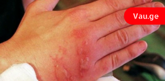 ნახეთ რა უნდა მოიმოქმედოთ დამწვრობის დროს – ამის ცოდნა ყველას სჭირდება!!!