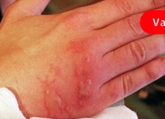 ნახეთ რა უნდა მოიმოქმედოთ დამწვრობის დროს – ამის ცოდნა ყველას სჭირდება!!!