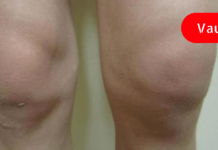 სახსრების გაუსაძლისი ტკივილის დროს სარეცხი საპონის და კომბოსტოს კომპრესები ყველაზე მეტად მეხმარება!