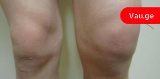 სახსრების გაუსაძლისი ტკივილის დროს სარეცხი საპონის და კომბოსტოს კომპრესები ყველაზე მეტად მეხმარება!