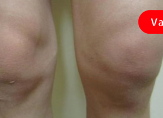 სახსრების გაუსაძლისი ტკივილის დროს სარეცხი საპონის და კომბოსტოს კომპრესები ყველაზე მეტად მეხმარება!