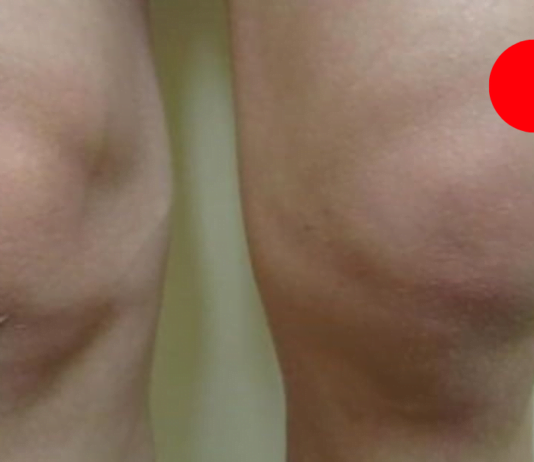 სახსრების გაუსაძლისი ტკივილის დროს სარეცხი საპონის და კომბოსტოს კომპრესები ყველაზე მეტად მეხმარება!