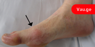 მარტივად მოიცილით შარდმჟავას კრისტალები და სამუდამოდ დაივიწყეთ პოდაგრა!