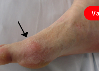 მარტივად მოიცილით შარდმჟავას კრისტალები და სამუდამოდ დაივიწყეთ პოდაგრა!