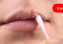 ხალხური მეთოდები, რომლებიც ერთ დღეში გაგათავისუფლებენ ჰერპესისგან!