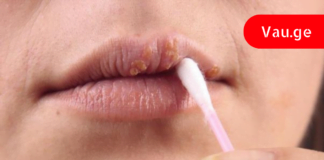 ხალხური მეთოდები, რომლებიც ერთ დღეში გაგათავისუფლებენ ჰერპესისგან!
