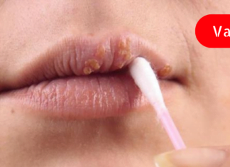ხალხური მეთოდები, რომლებიც ერთ დღეში გაგათავისუფლებენ ჰერპესისგან!