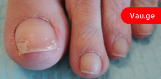 მე ტერფის სოკო ამ რეცეპტით მოვირჩინე! აი რა გავაკეთე…