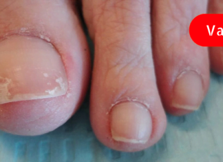 მე ტერფის სოკო ამ რეცეპტით მოვირჩინე! აი რა გავაკეთე…