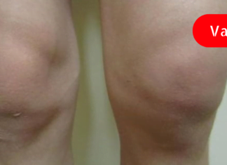 Ხალხური საშუალებები მუხლის ტკივილის შესამსუბუქებლად : სარეცხი საპონის და კომბოსტოს კომპრესები მე ყოველთვის მეხმარება!