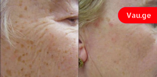 დაემშვიდობეთ ჭორფლს!ეს ინგრედიენტები სამუდამოდ მოგაშრებთ მათ!