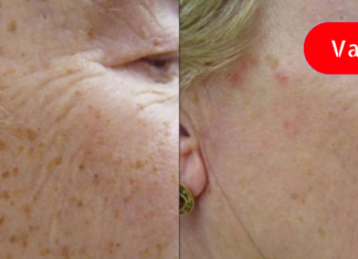 დაემშვიდობეთ ჭორფლს!ეს ინგრედიენტები სამუდამოდ მოგაშრებთ მათ!