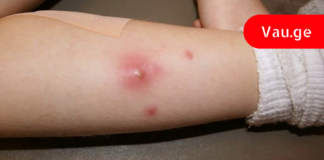 ამის შემდეგ სამუდამოდ განიკურნებით ძირმაგარასგან – დროში გამოცდილი რეცეპტები !