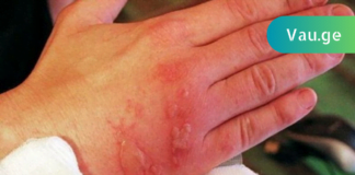 ნახეთ რა უნდა მოიმოქმედოთ დამწვრობის დროს – ამის ცოდნა ყველას გჭირდებათ!