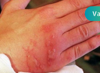 ნახეთ რა უნდა მოიმოქმედოთ დამწვრობის დროს – ამის ცოდნა ყველას გჭირდებათ!