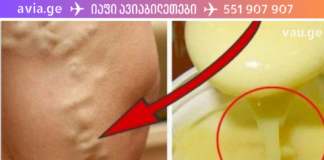 სახლში დამზადბული  მალამო ვარიკოზული ვენებისთვის, რომელმაც დედაჩემი გადაარჩინა ოპერაციისგან