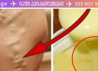 სახლში დამზადბული მალამო ვარიკოზული ვენებისთვის, რომელმაც დედაჩემი გადაარჩინა ოპერაციისგან