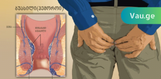 მეთოდი რომელიც აუცილებლად უნდა იცოდეთ თუ თქვენ ბუასილი გაწუხებთ