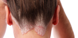 რა არის ფსორიაზი? – დაავადების სიმპტომები და დერმატო-ვენეროლოგის დროული ჩართულობის როლი psoriasis on the hairline and on the scalp